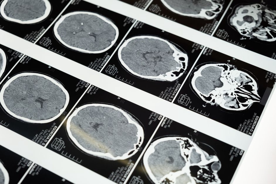 deformed grid overlaying fused MRI and CT brain scan showing non-rigid registration