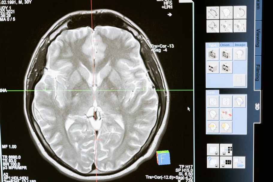 A boundary overlay on a grayscale medical scan